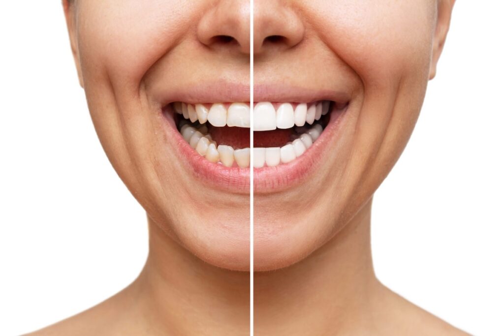veneers